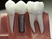 Dental implant